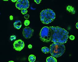 Hereditary Cancer Screening for Women